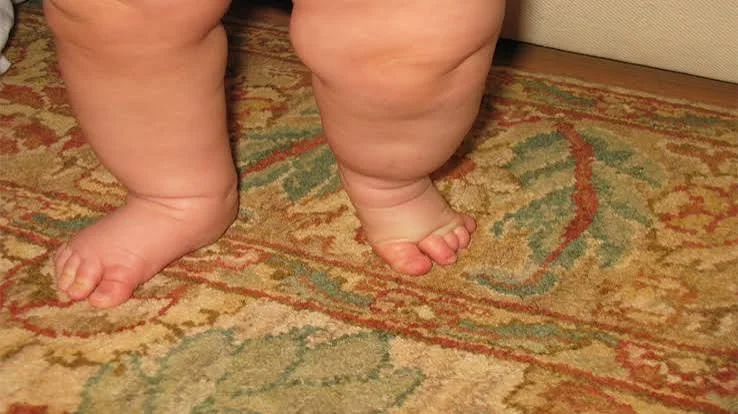 Tibial Hemimelia in Children and Treatment Methods: Current Surgeries in Congenital Tibia Deficiency