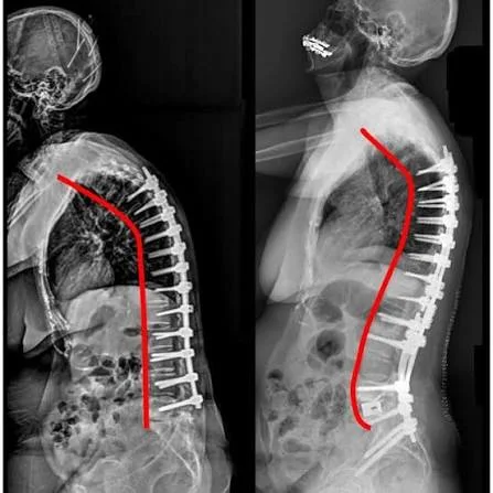 Spine Surgery (Scoliosis) and Special Fields (Hand Surgery, Tumor Surgery)