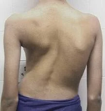 Skolyoz ve Omurga Deformitelerinde Erken Teşhis ve Güncel Tedavi Yöntemleri