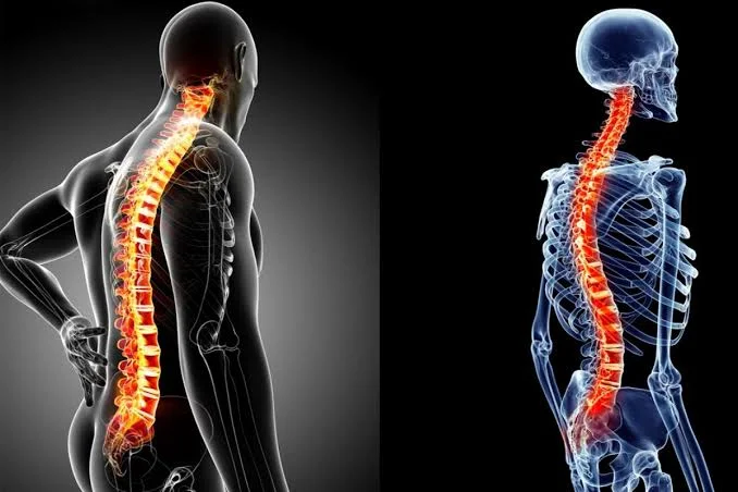 Skolyoz ve Omurga Deformitelerinde Erken Teşhis ve Güncel Tedavi Yöntemleri