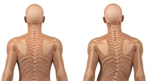 Skolyoz ve Omurga Deformitelerinde Erken Teşhis ve Güncel Tedavi Yöntemleri