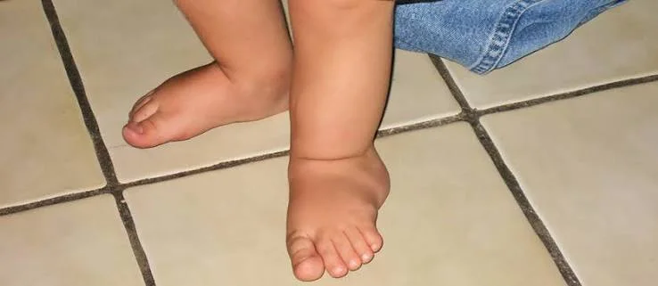 Fibular Hemimelia in Children and Treatment Methods: Limb-Sparing Surgeries for Congenital Leg Shortness
