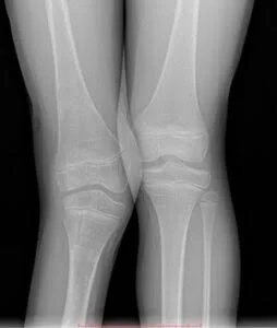 Fibular Hemimelia in Children and Treatment Methods: Limb-Sparing Surgeries for Congenital Leg Shortness