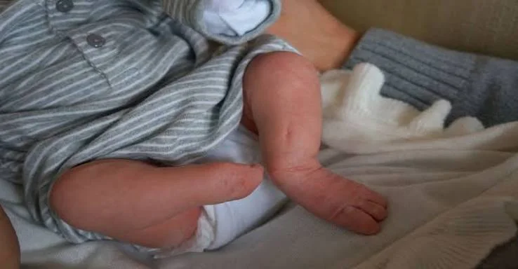 Tibial Hemimelia in Children and Treatment Methods: Current Surgeries in Congenital Tibia Deficiency