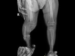 Tibial Hemimelia in Children and Treatment Methods: Current Surgeries in Congenital Tibia Deficiency