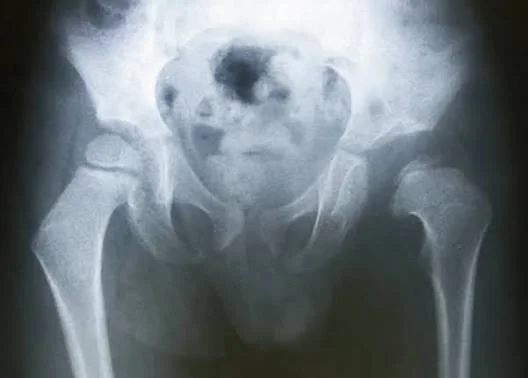 Hip Dislocation Treatment in Infants and Children: From Early Diagnosis to Current Surgical Methods