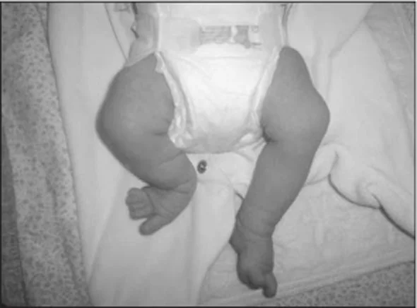 Fibular Hemimelia in Children and Treatment Methods: Limb-Sparing Surgeries for Congenital Leg Shortness