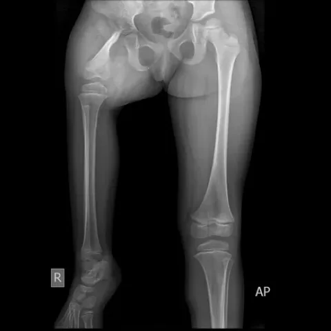 Proximal Femoral Focal Deficiency (PFFD) in Children and Current Treatment Methods