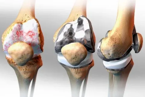 Prosthesis Surgery for Advanced Joint Calcification: Knee and Hip Prosthesis Surgeries