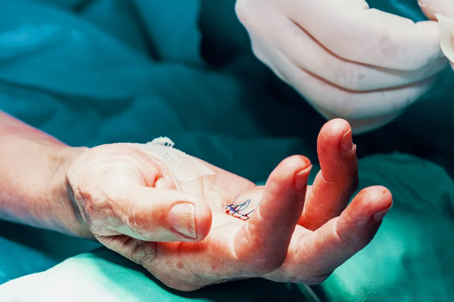 Hand Surgery