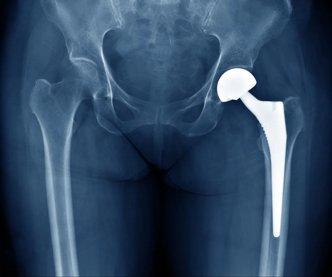 Hip Dislocation