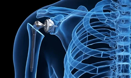 Prosthetic Surgery