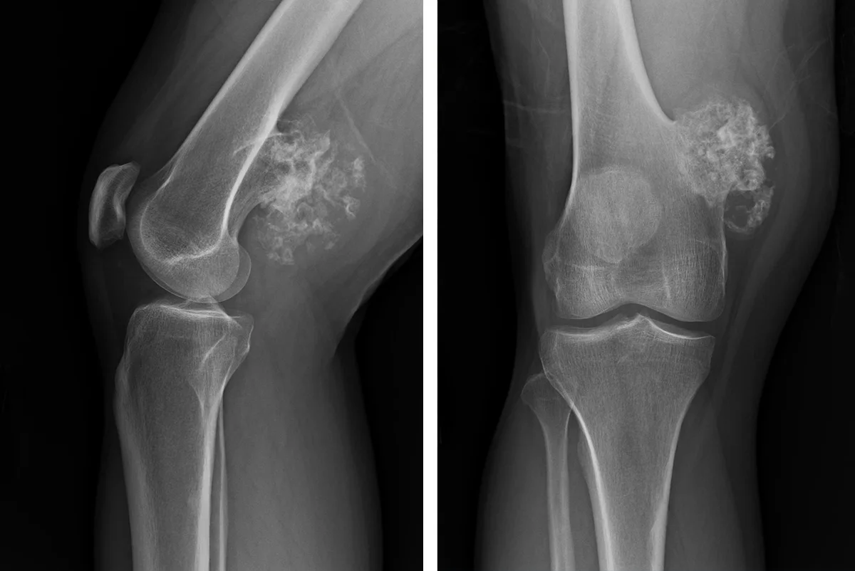 Tumor Surgery
