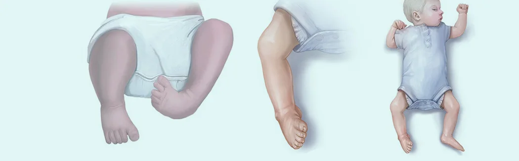 Pediatric Orthopedics