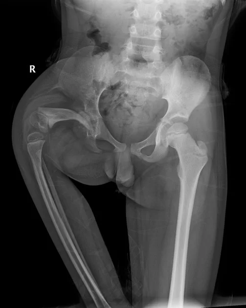 Proximal Femoral Focal Deficiency (PFFD)