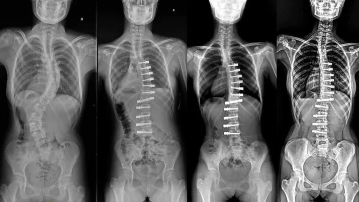 scoliosis